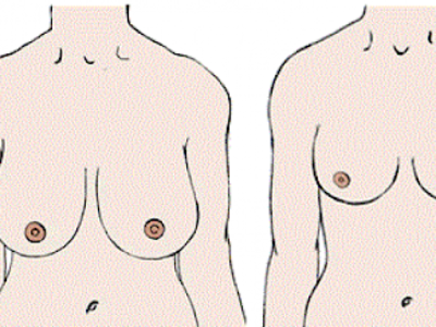 Redução mamária ajuda a evitar lesões no ombro e na coluna