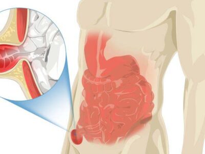 Hérnia inguinal atinge 20% dos homens em alguma fase da vida