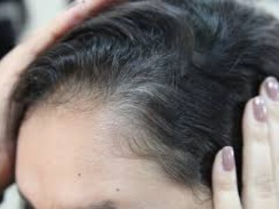 Estudo comprova eficácia de medicamento para perda de cabelo em mulheres