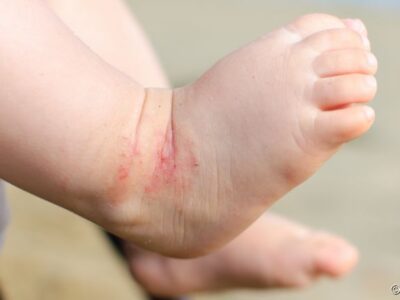 Dermatite Atópica: hidratação diária desde o nascimento pode aliviar os sintomas