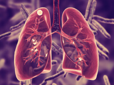 Câncer de pulmão é o que mais mata no Brasil, mas pode ser evitado. Veja como e previna-se!