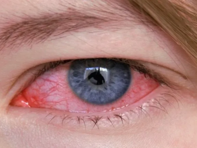 Olhos vermelhos: maior causa de urgências oftalmológicas no pais. Veja as possíveis doenças