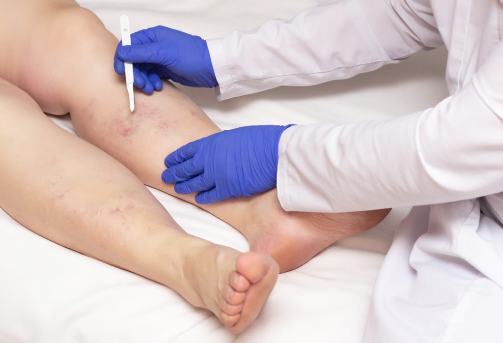 Como prevenir e tratar as doenças venosas?