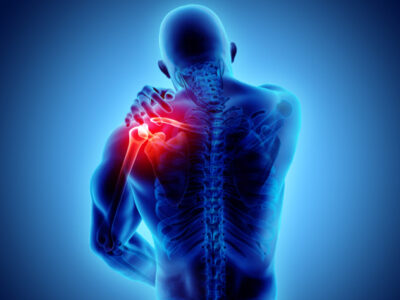 Bursite no ombro: entre os principais sintomas estão a fraqueza e repetição de movimentos muscular. Veja como evitar