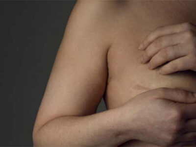 ‘Não senti nada’, diz paciente de tratamento inédito que ‘congela’ câncer de mama