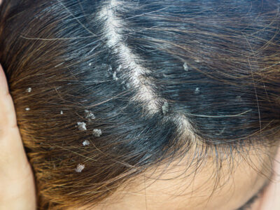 Sinais de câncer no couro cabeludo que podem ser confundidos com caspa