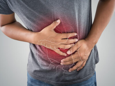Os 7 fatores que aumentam o risco de câncer de intestino