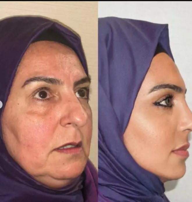 ‘Antes e depois’ de cirurgia plástica em idosa causa polêmica na internet