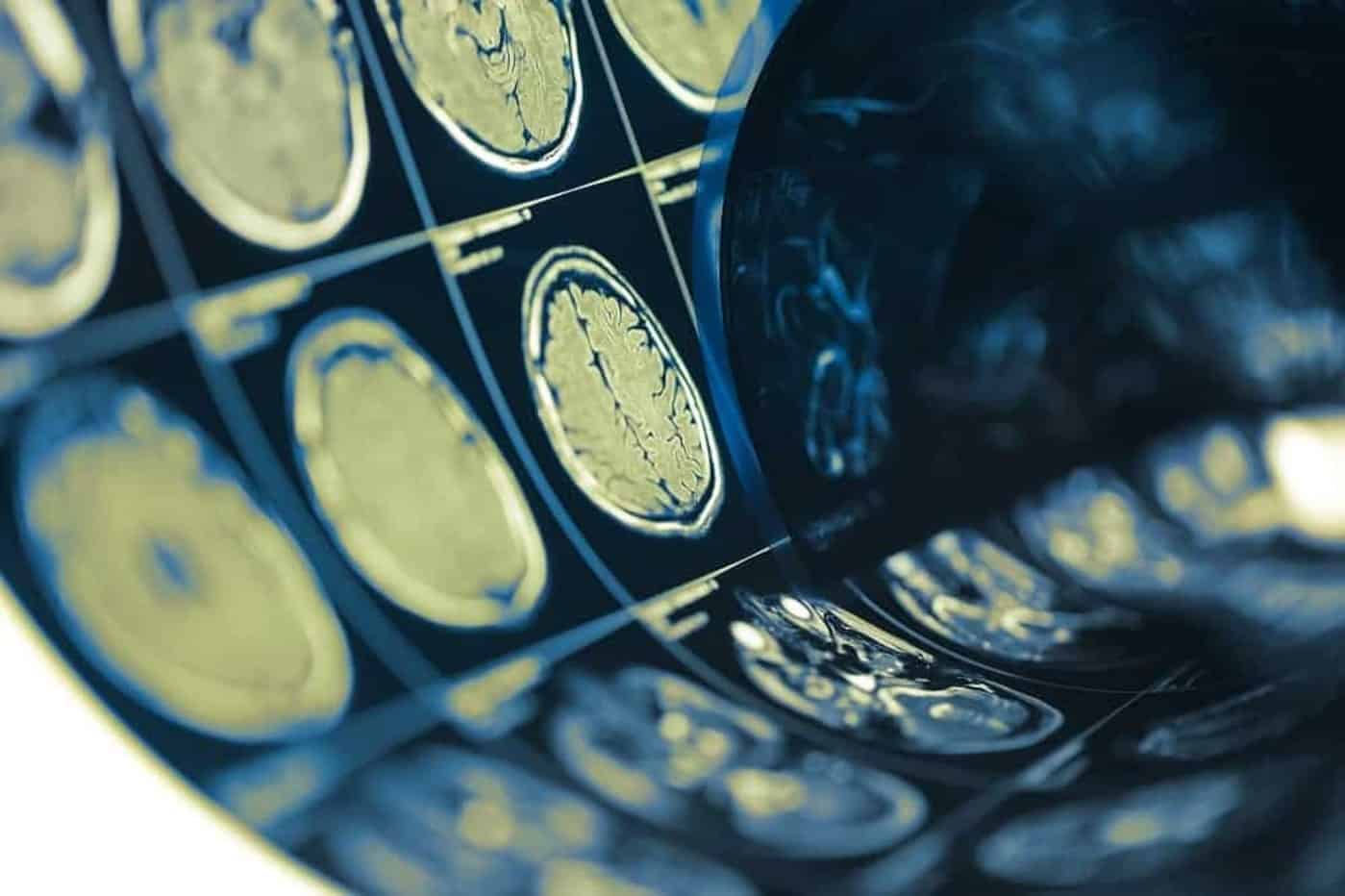 AVC pode matar 10 milhões de pessoas por ano até 2050, alerta estudo