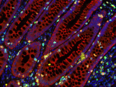 Câncer de intestino: descoberta pode auxiliar no tratamento da doença