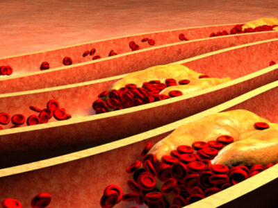 Sintoma de colesterol alto causa dor forte em uma parte do corpo