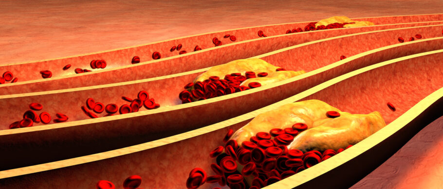 Sintoma de colesterol alto causa dor forte em uma parte do corpo