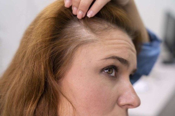 Anvisa aprova novo medicamento ‘milagroso’ para queda de cabelo
