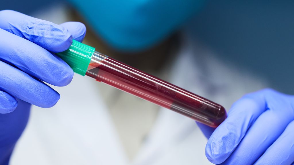 Exame de sangue prevê risco de Alzheimer com décadas de antecedência