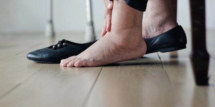 5 sinais de pés inchados que você deve começar a se preocupar