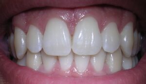 Clareamento faz mal aos dentes?