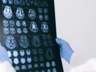 Estudo revela o que pode causar a morte de neurônios no Alzheimer