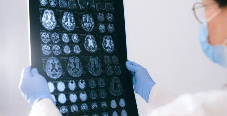 Estudo revela o que pode causar a morte de neurônios no Alzheimer