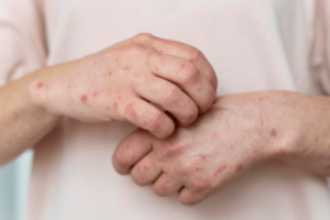 Alerta: vacina contra catapora está em falta e isso pode comprometer seu filho. Entenda!