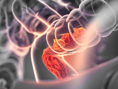 Conheça a vitamina que é a chave para reduzir o risco de câncer de intestino