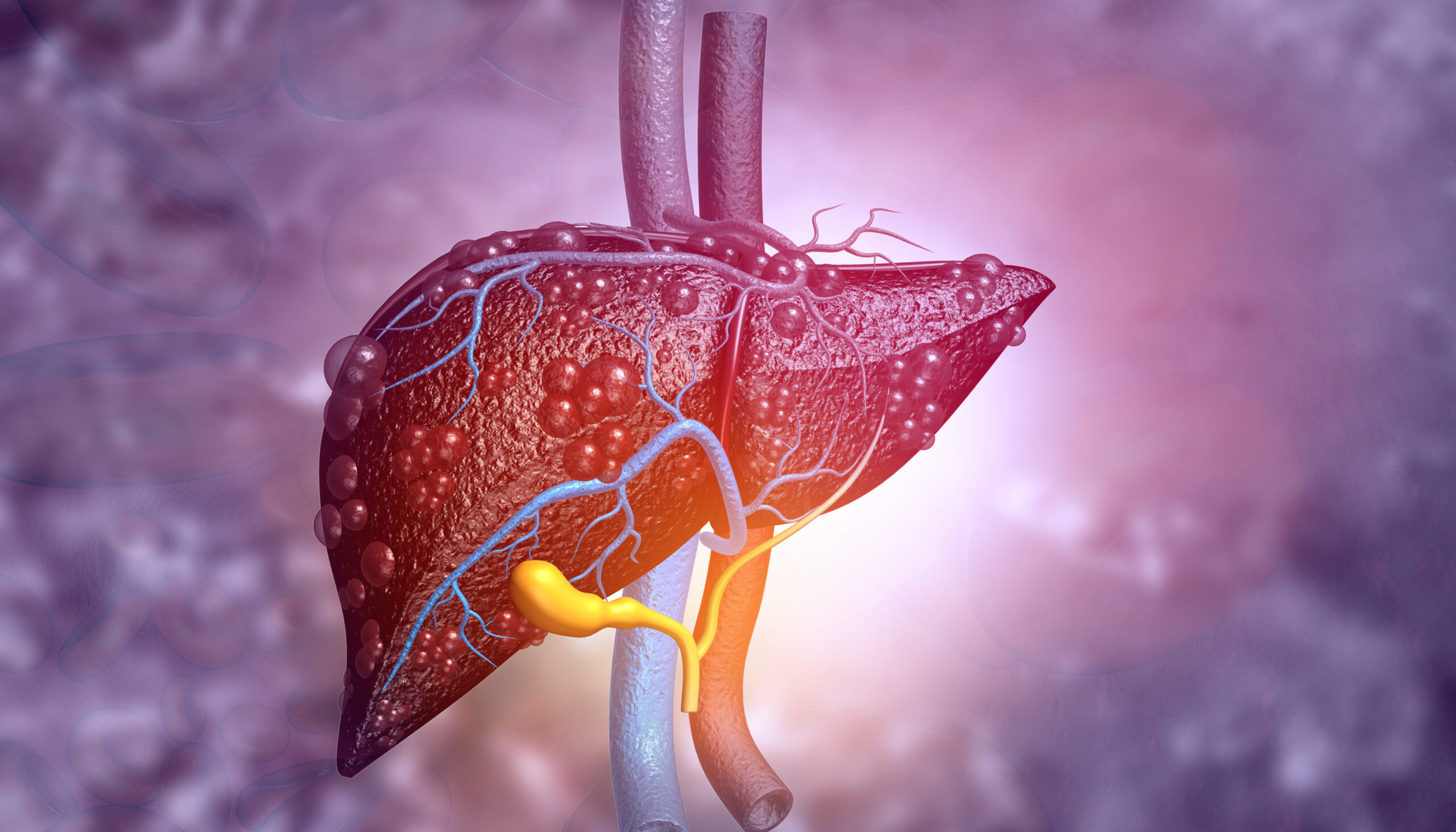 5 sinais de que você pode estar com grave doença hepática