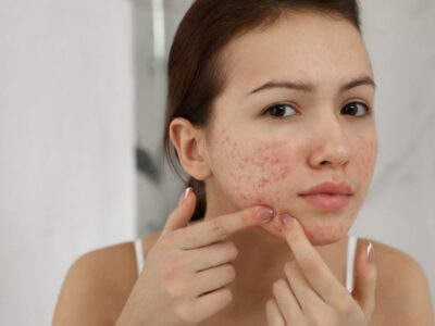 Pele seca e com acne: como tratar e que produtos usar