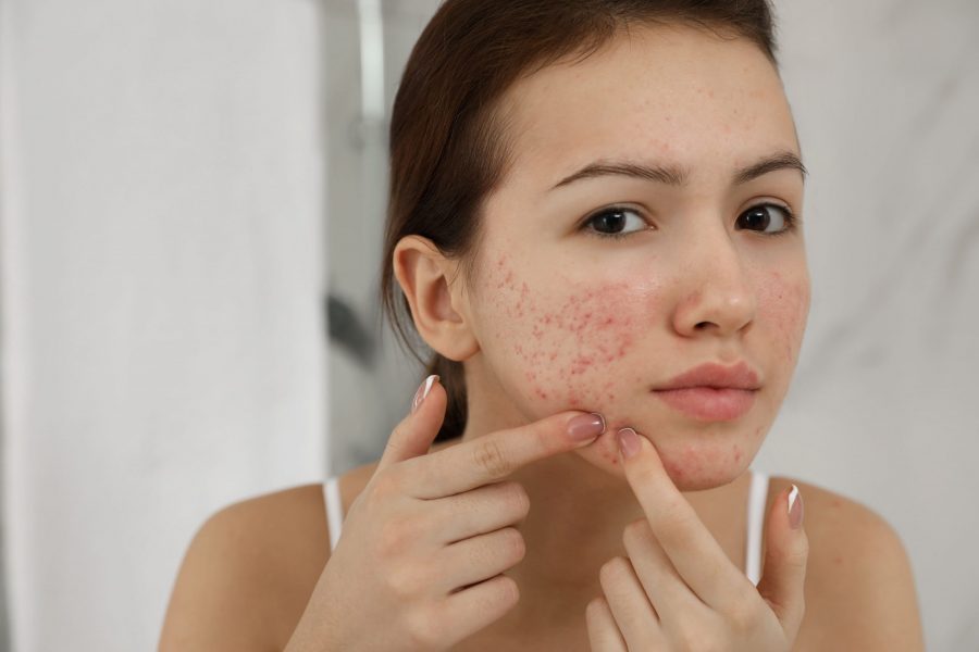 Pele seca e com acne: como tratar e que produtos usar