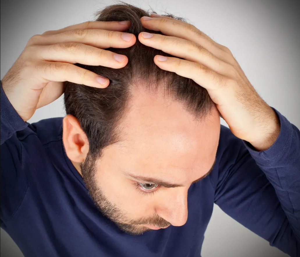 Calvície: o que é, sintomas, causas e tratamento