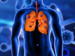 Tuberculose: a importância de detectar o mais rápido e tratar. Unimagem, referência em diagnóstico precoce, explica. Entenda!