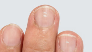 O que é a mancha branca que aparece na unha; veja as causas