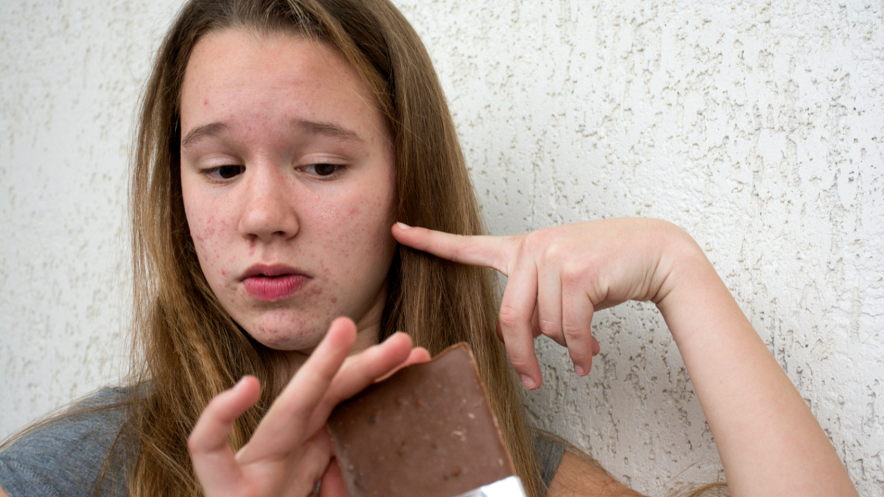 É verdade que chocolate dá espinha? Veja o que diz a ciência