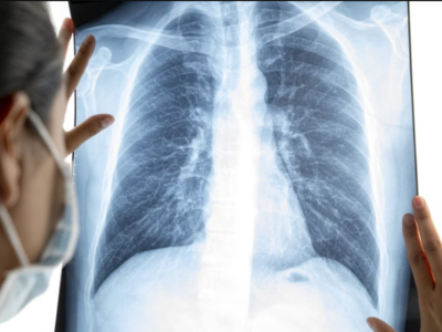 Medicamento inovador contra câncer de pulmão agressivo dá 7 vezes mais sobrevida