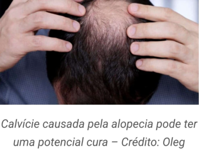 Tratamento promissor pode curar a calvície associada à alopecia