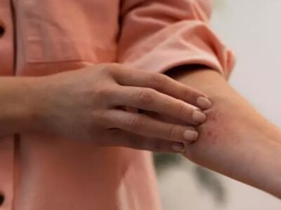 Dermatite Atópica: Sintomas e tratamento