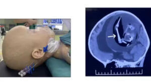 Médicos encontram feto com braços, olhos e cabelos dentro de crânio de menina de 1 ano