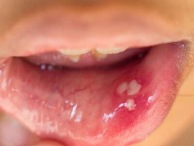 Afta pode ser sintoma de câncer de boca: veja principais sintomas da doença e importância do diagnóstico precoce