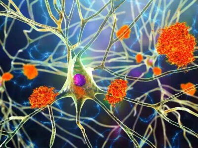 Cientistas brasileiros descobrem molécula promissora para o tratamento do Alzheimer