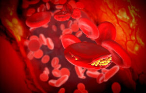 Rosto, mãos e pernas: conheça os sintomas de colesterol alto que podem aparecer pelo seu corpo