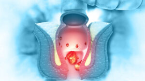 10 alimentos que podem piorar hemorróidas. Saiba o que comer.