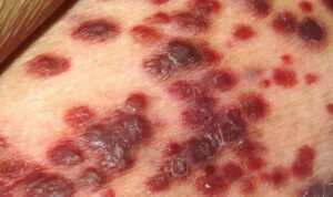 Conheça os primeiros sintomas do HIV, que podem aparecer duas semanas após a exposição ao vírus