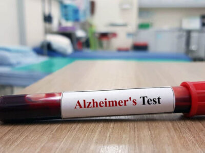 Exames de sangue podem ajudar no diagnóstico precoce do Alzheimer