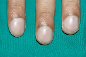 Unhas que se curvam em direção à ponta dos dedos podem ser um sinal de câncer de pulmão; Entenda esse e outros sintomas