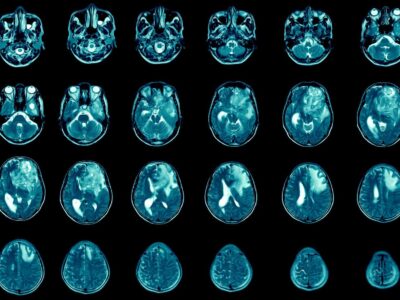 Antidepressivo mostra potencial no tratamento de câncer incurável. É o que revelam estudos recentes realizados no ETH e Hospital Universitário de Zurique, na Suíça