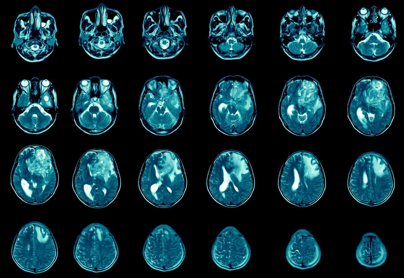 Antidepressivo mostra potencial no tratamento de câncer incurável. É o que revelam estudos recentes realizados no ETH e Hospital Universitário de Zurique, na Suíça