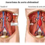 O que é aneurisma da aorta? Entenda sintomas e tratamento