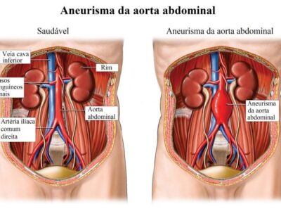 O que é aneurisma da aorta? Entenda sintomas e tratamento