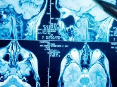 Poluição do ar pode ter efeitos graves na saúde cerebral; saiba mais