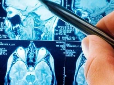 Modelo de IA pode detectar um tumor cerebral cancerígeno em 10 segundos