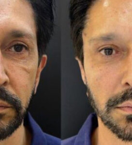 Reeleito, Ricardo Nunes faz harmonização facial; veja imagens