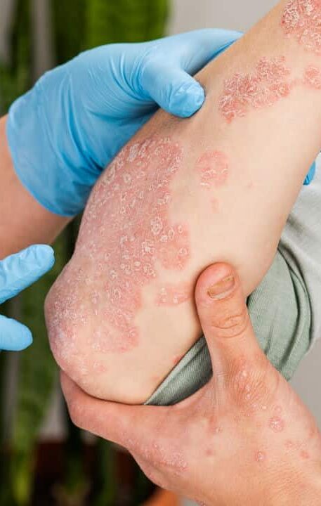 Descubra o segredo para combater a psoríase naturalmente; confira pesquisa